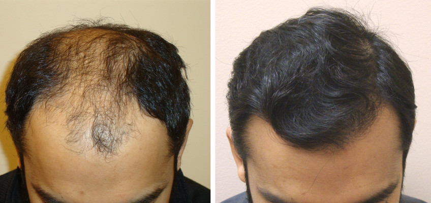 How to Choose Your Hair Transplant Surgeon