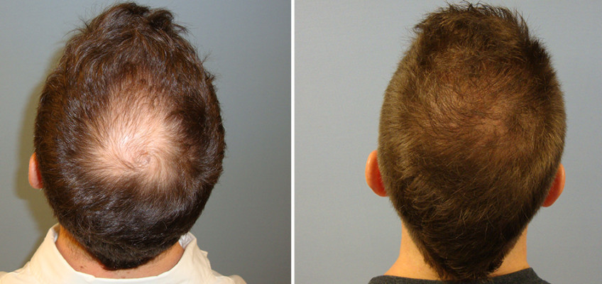 Is it possible to have a scarless hair transplant?