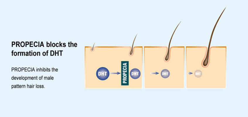 Propecia and Rogaine Treatment for Hair Loss